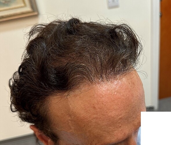 Hair Transplant Outcome with 4000 Grafts Across NW5 Zone – HDC Hair Clinic photo