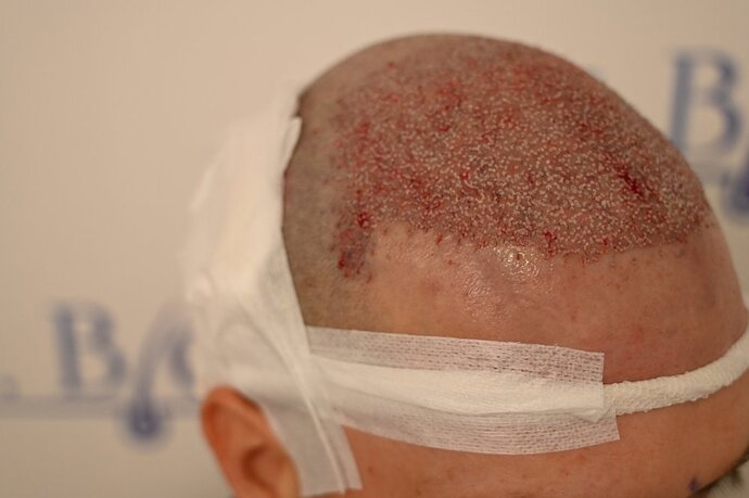 Ozlem Bicer MD-Hair Transplant-3980 Grafts FUE by micro-motor, 12. months result photo