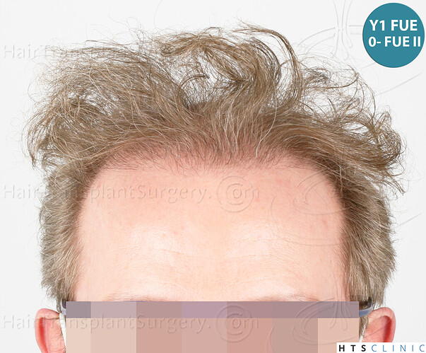 Dr. Jean Devroye, HTS Clinic / 6494 FUE-BHT (3150 + 3344) / NW VII, 2 sessions photo