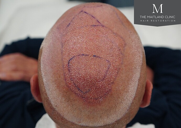 Dr Ball - The Maitland Clinic 2280 Grafts by FUE photo