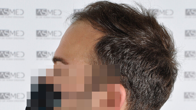 ASMED CLINIC - Koray Erdogan - MANUAL FUE Hair Transplant Result - 3806 grafts photo