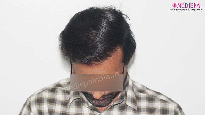 Revision Hair Transplant - 5111 Grafts / 5 Years Result - Dr. Suneet Soni, Medispa India photo