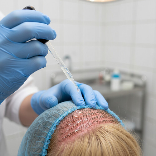 PRP Treatment for Hair Transplants: Enhancing Growth and Graft Survival