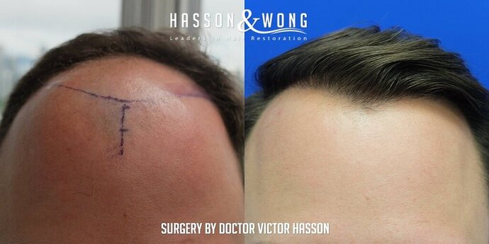 Dr. Hasson / 4,511 grafts / FUE / Frontal zone /mid / 3 years post-op photo