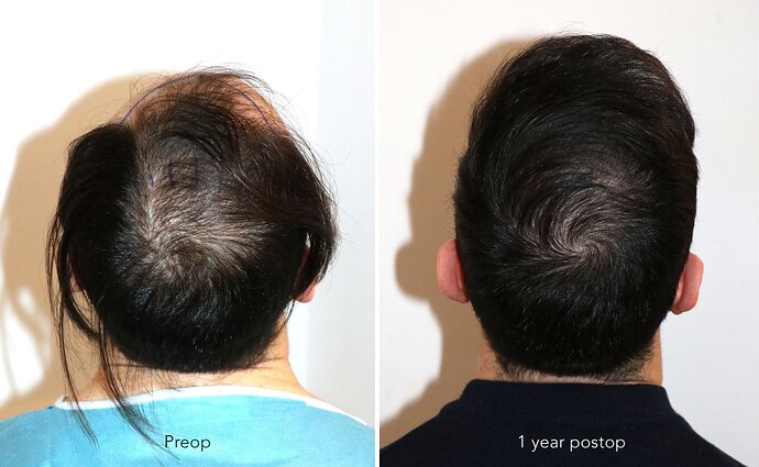 Case performed by Dr. Feriduni – 3744 FU in 1 procedure photo