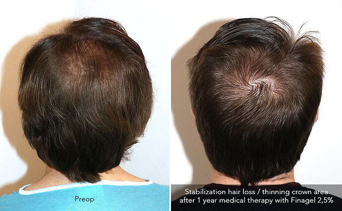 Case performed by Dr. Feriduni – 3322 FU in 1 procedure photo