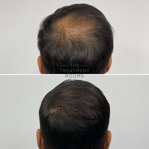 1411 Grafts Hairline and Crown Result- The Treatment Rooms London photo