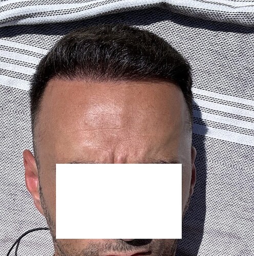 Two FUE Surgeries Totaling 6560 Grafts – HDC Hair Clinic photo