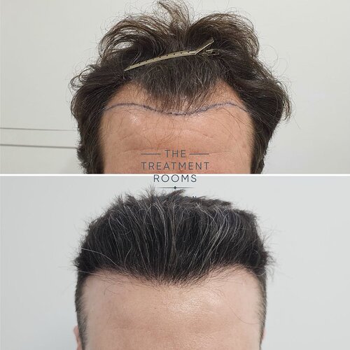 Hairline Transplant- 1745 Grafts- 14 Months Post Surgery photo