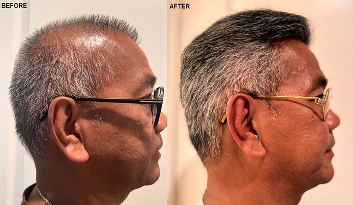 AlviArmani new FUE result 3,500 grafts - Dr. Hughes photo