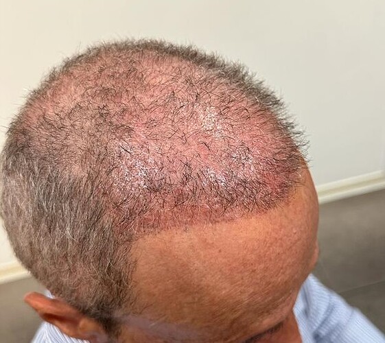 Hair Transplant Outcome with 4000 Grafts Across NW5 Zone – HDC Hair Clinic photo