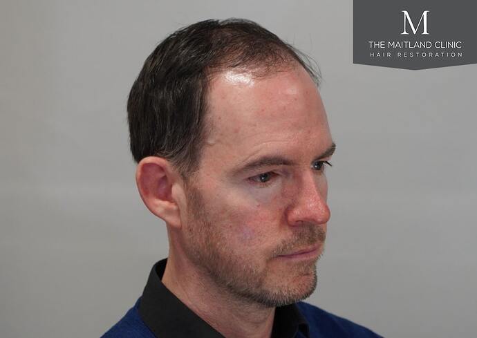 Dr Ball - The Maitland Clinic 1432 Grafts By FUE photo