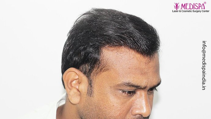 Dr. Suneet Soni - 5498 Grafts, 2 Years Result, Combine FUT + FUE + Beard Technique, NW-VI photo