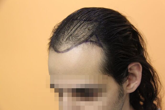 Dr.Bisanga, BHR Clinic, 2988 FUE 0 - 12 Months photo