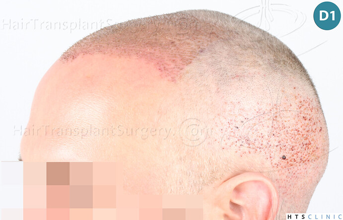 Dr Devroye + Dr Montesanti + Dr Jenard, HTS Clinic / 2932 FUE / Hairline & frontal area photo