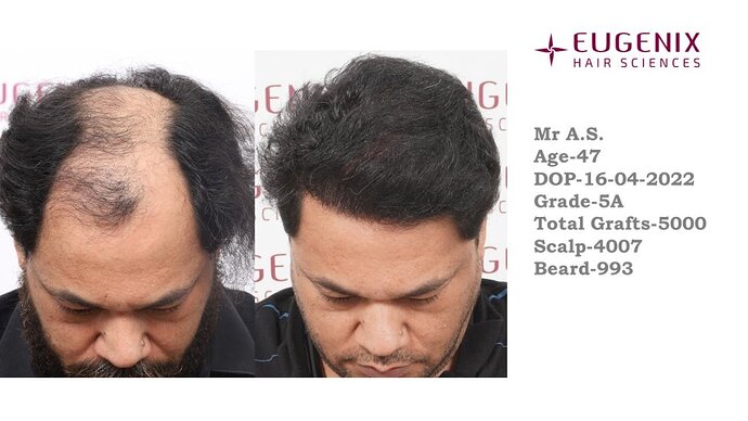 EUGENIX HAIR SCEINCES | GRADE 5A | 11.5 MONTHS RESULT photo