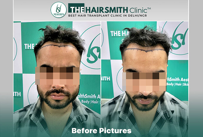 The HairSmith Clinic™ | NW Stage 3 | 1675 Grafts | 9 Months Hair Transplant Result photo