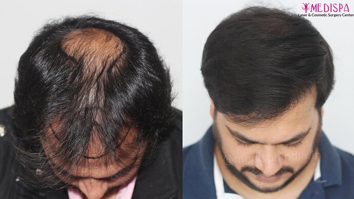 Dr. Suneet Soni - 4937 Grafts, Combine FUT + FUE Technique, NW : IV-V photo