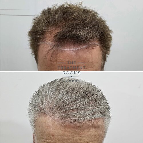 2129 Grafts Hairline, Temples and Crown Restoration photo