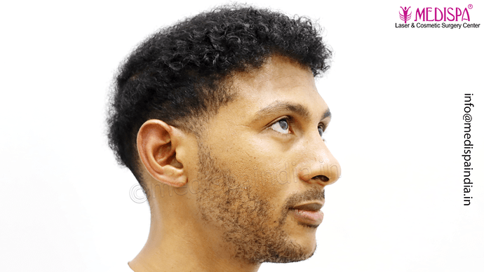 Dr. Suneet Soni - Afro Hair Transplant, 2 Sessions, 8355 Grafts, Combined FUT + FUE Technique, NW-VI, 5 Years Result photo