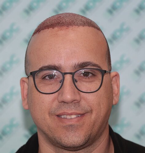 HDC Hair Clinic – FUE Hair Transplant Result for 4534 Grafts photo