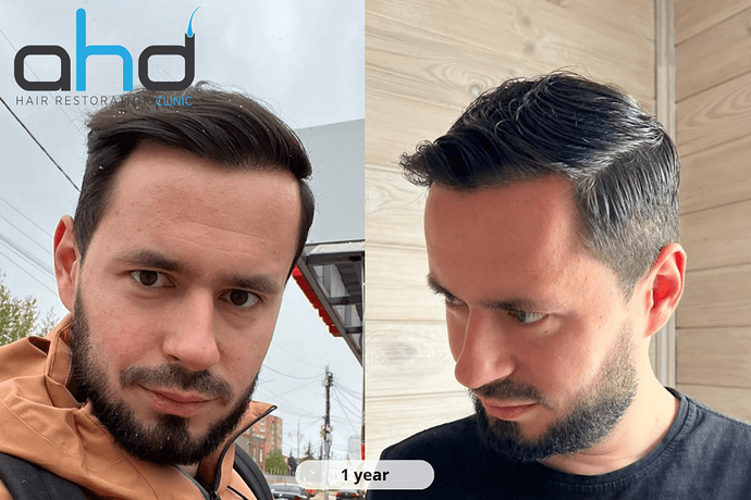 AHD Clinic / Dr.Hakan Doganay's Team / 4300 grafts / DHI + FUE photo