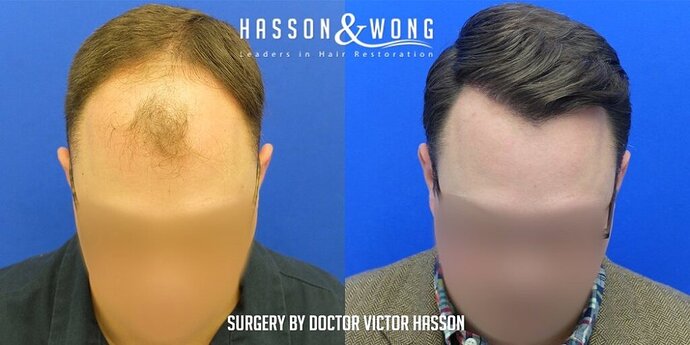 Dr. Hasson / 4,511 grafts / FUE / Frontal zone /mid / 3 years post-op photo