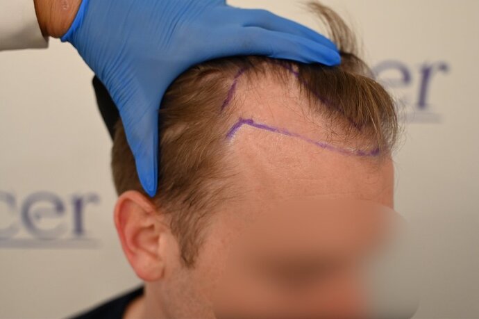 Ozlem Bicer MD-Hair Transplant-2720 Grafts FUE by micro-motor, 9. months result photo
