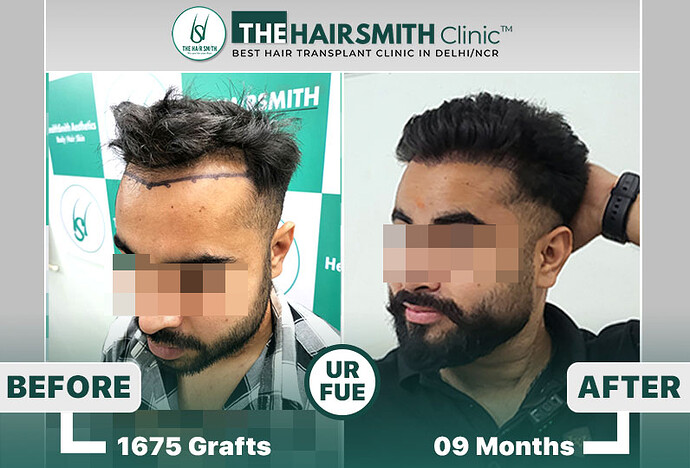 The HairSmith Clinic™ | NW Stage 3 | 1675 Grafts | 9 Months Hair Transplant Result photo