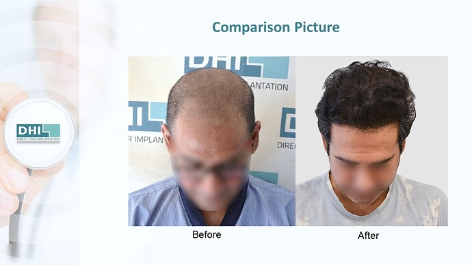 DHI India™ | NW 4 | 3,759 Grafts | 1 year DHI Hair Transplant Results photo