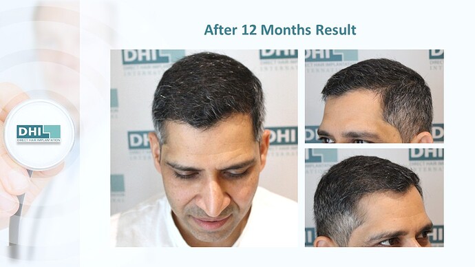 DHI India™ | NW 5 | 2,985 Grafts | 12 Months DHI Hair Transplant Results photo