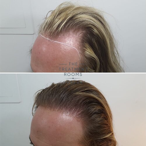 Hairline Feminisation FUE Surgery 1509 grafts- The Treatment Rooms London photo