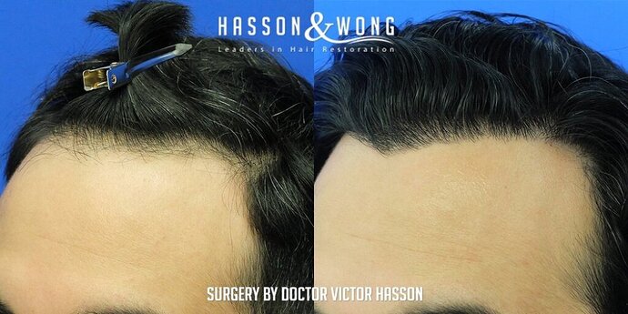 Dr. Hasson / 2,500 grafts / FUE / Hairline / 1 Year Post-op photo