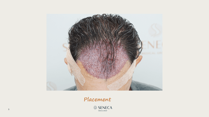 Seneca Medical Group - 1700 grafts with Direct Fue photo