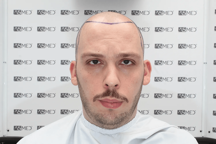 ASMED, Istanbul: 5,071 Manual FUE Grafts 0/12 Months photo
