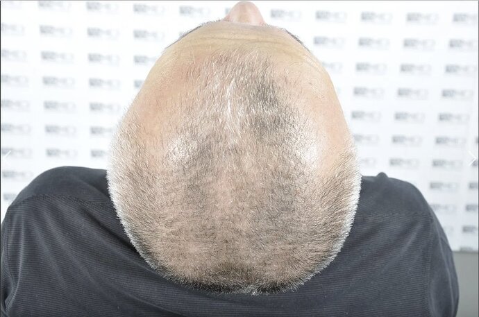 Asmed Clinic - FUE Hair Transplant - 5041 Grafts photo
