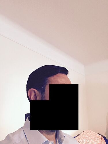 DR HAKAN DOGANAY/4055 GRAFTS/FUE+Implanter Pen photo
