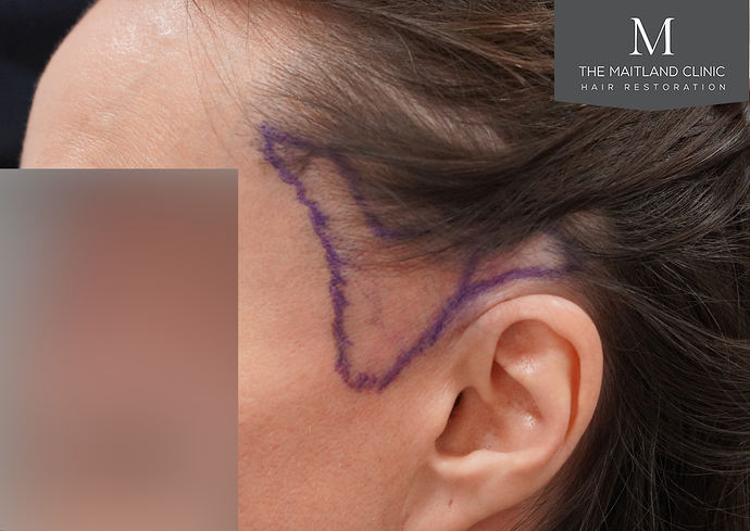 Female Temporal Point Restoration - 607 FUE Grafts photo