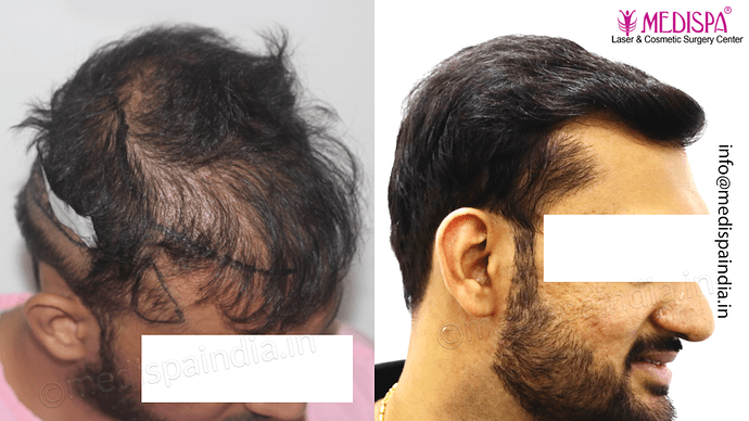 Dr. Suneet Soni - 4665 Grafts, Combine FUT + FUE + BHT (Beard) Technique photo