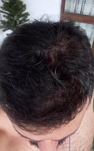DR HAKAN DOGANAY/ 4500 GRAFTS / Implanter Pen+FUE photo