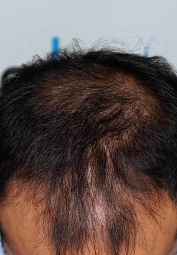 DR HAKAN DOGANAY/ 4500 GRAFTS / Implanter Pen+FUE photo