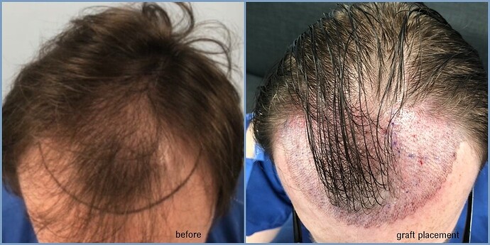 Dr. Nikos - hairline to mid-scalp hair restoration - 2400 grafts @ 6 months progress photo