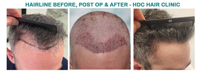 Result of Class 3V Patient – 3530 Grafts – HDC Hair clinic – Dr Maras photo