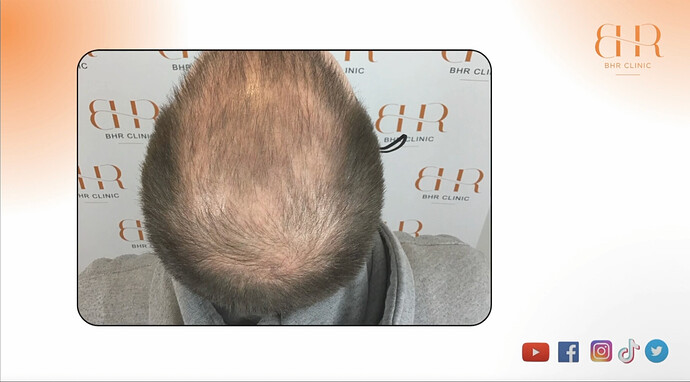 Dr. Bisanga and Dr. Kostis BHR Clinic - MEGA-Sessions FUE/Body Hair Repair Patient - 9917 Grafts NW6 - Full coverage! Patient video included! photo