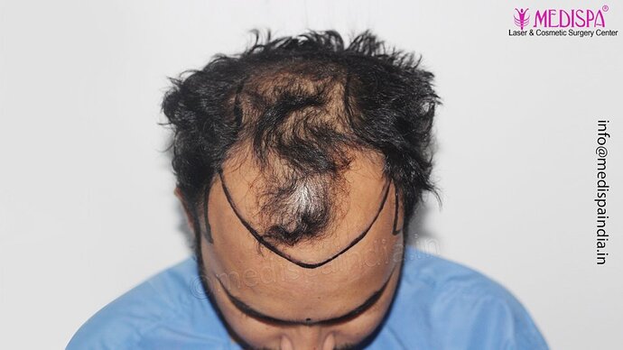 Dr. Suneet Soni - 5000 Grafts, Combine FUT + FUE + Beard Technique, NW-V photo