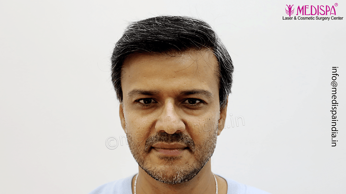 Dr. Suneet Soni - 4889 Grafts | 2.5 Years Result | Combination FUT + FUE + Beard photo