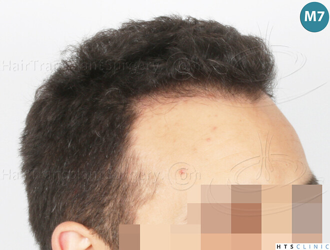 Dr Devroye + Dr Montesanti + Dr Jenard, HTS Clinic / 2018 FUE / Hairline & frontal area photo