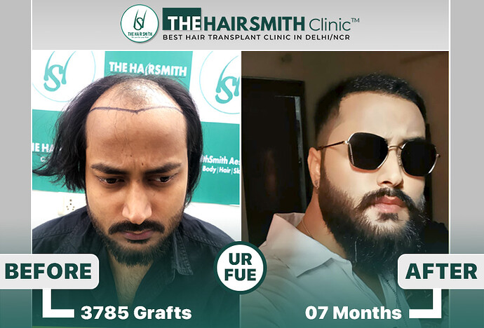 The HairSmith Clinic Delhi | NW Stage 6 | 3785 Grafts | 11 Months Hair Transplant Result photo