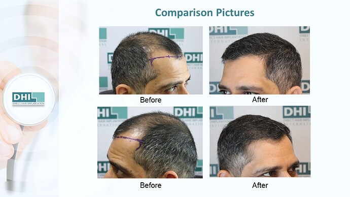 DHI India™ | NW 5 | 2,985 Grafts | 12 Months DHI Hair Transplant Results photo