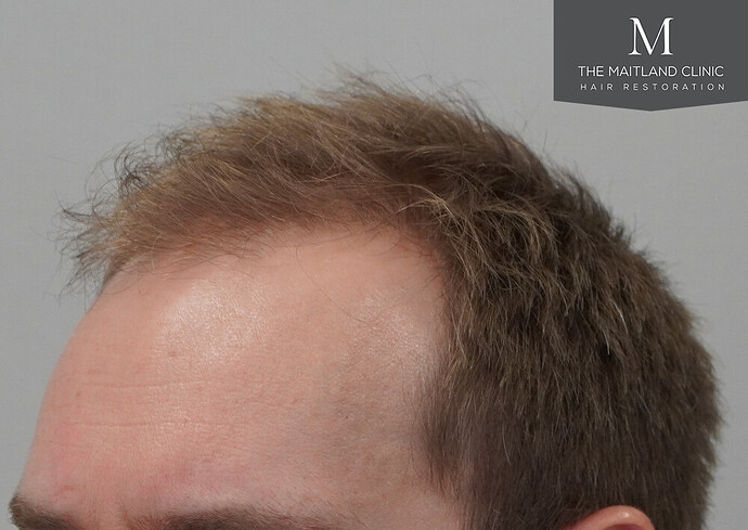 1826 grafts by FUE with Dr Edward Maitland Ball at The Maitland Clinic photo